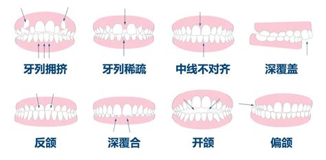 上排牙齒蓋住下排牙齒|介紹理想的咬合關係，整齊的牙齒排列應該是什麼樣。